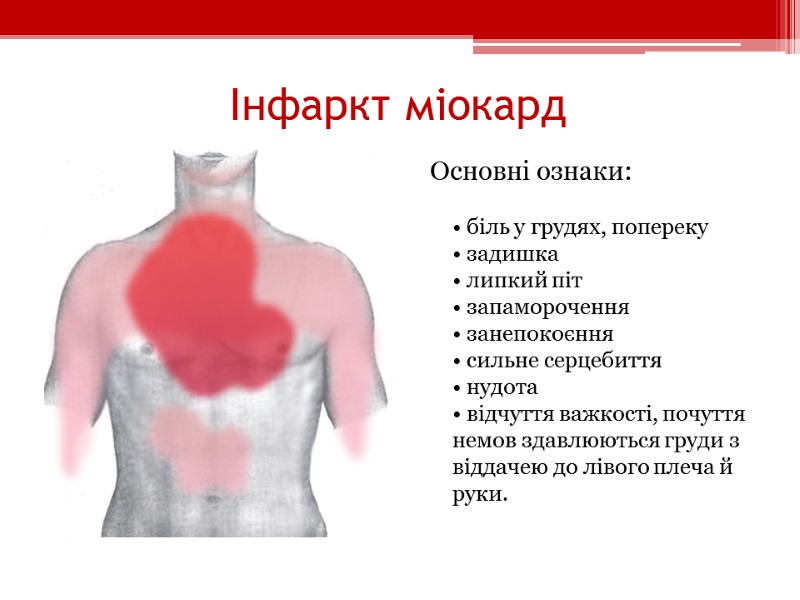 Інфаркт міокард Основні ознаки:  • біль у грудях, попереку • задишка • липкий